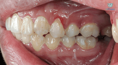 gums showing blood and signs of gum disease