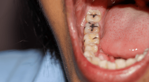 Closeup of child's mouth and teeth with several cavities