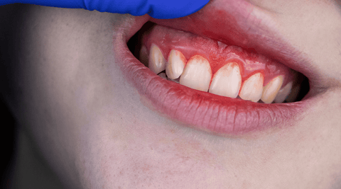 Young child's upper lip being pulled back to show red swollen gums