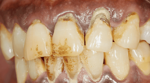 Closeup of unhealthy mouth and teeth with periodontitis