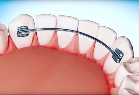 Graphic rendering of the inside of a mouth showing an orthodontic device
