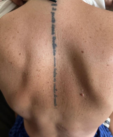 removal update : r/TattooRemoval