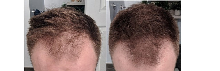 Left - Hair before treatment. Right - Hair after one year of treatment.