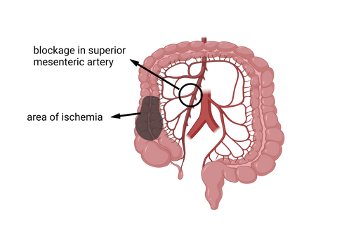 acute mesenteric ischemia