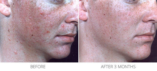 acne treatments for skin DermaConcepts Clinical Results â€“