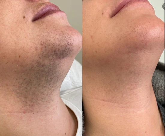 Before and After