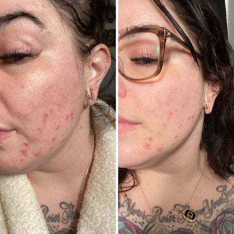 high frequency wand before and after