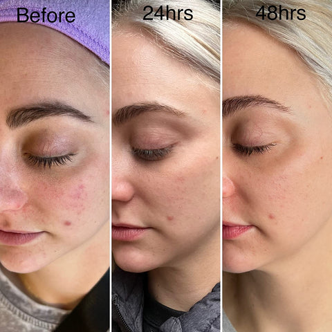 high frequency wand before and after