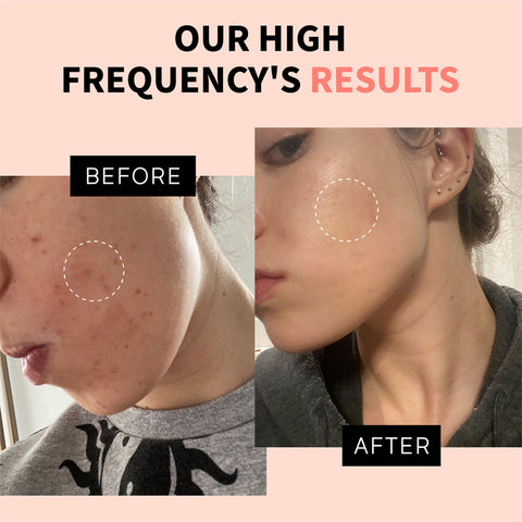 high frequency wand before and after