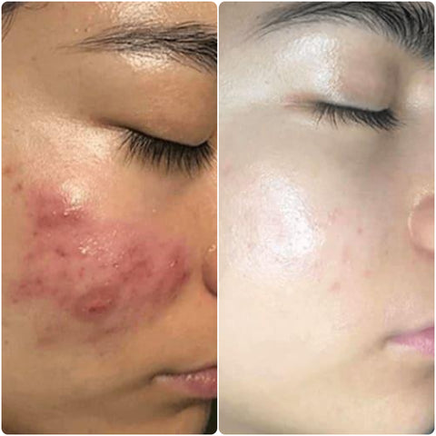high frequency facial wand before and after