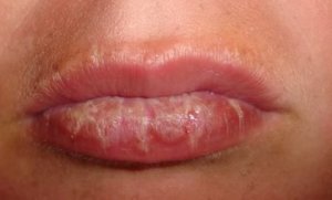 Blistering bottom lip from sunburn