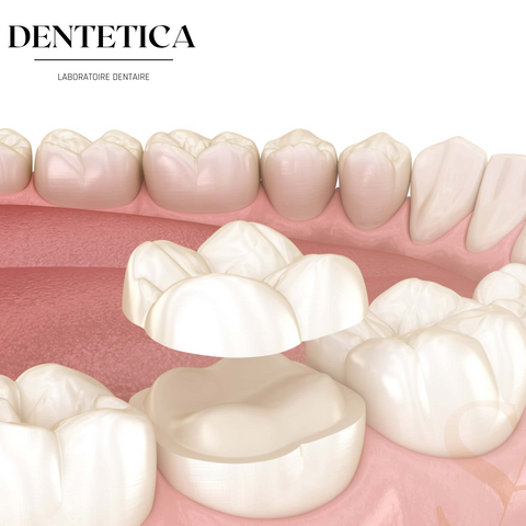 Onlay et inlay prothèse dentaire fixe