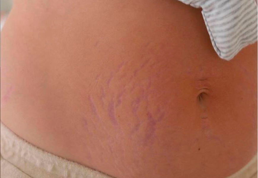 Pregnancy: how to reduce purple stretch marks? – Daylily Paris