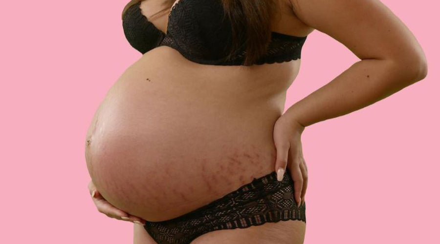 Avoiding stretch marks at the end of pregnancy