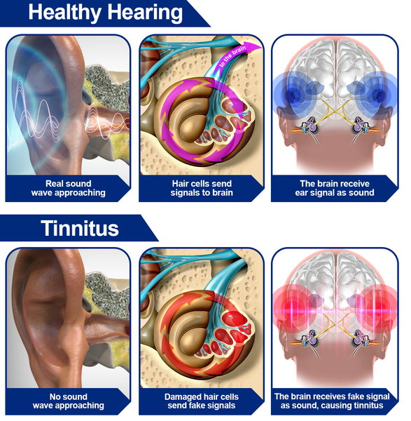 LUHAKA™ Infrapeace Red Light Therapy Ear Plugs