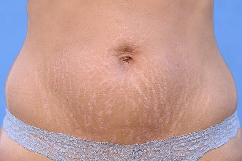 stretch marks on a post pregnant woman
