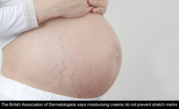 stretch marks on a pregnant women