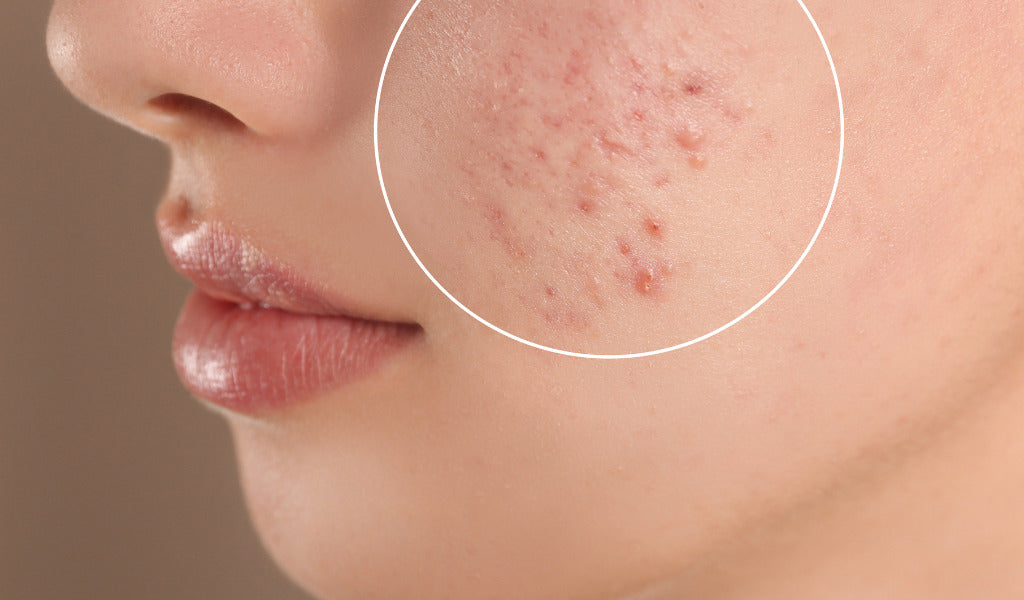 berberine in goldenseal may combat acne