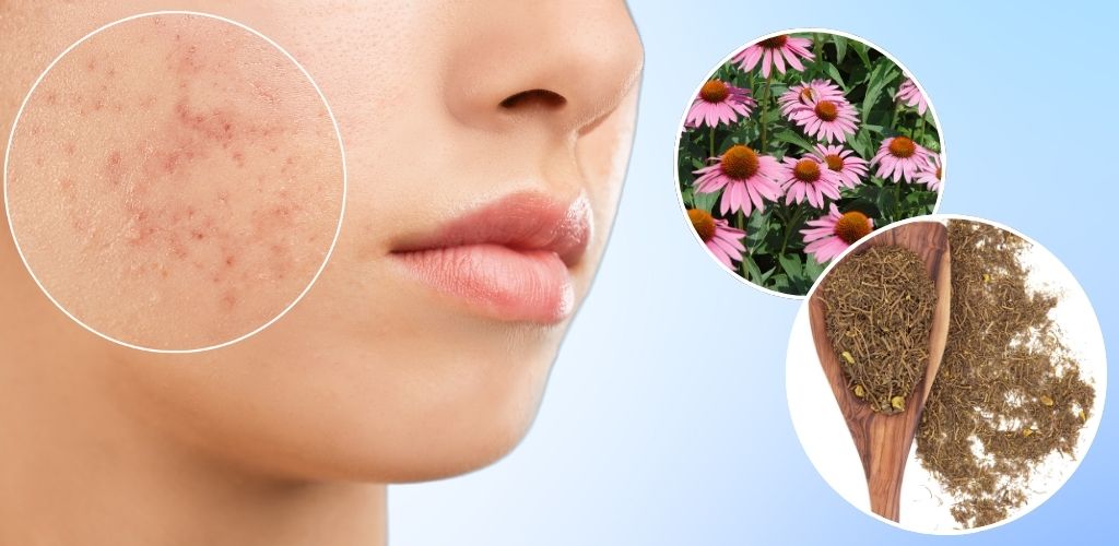 Goldenseal and echinacea are good for skin and reduce acne