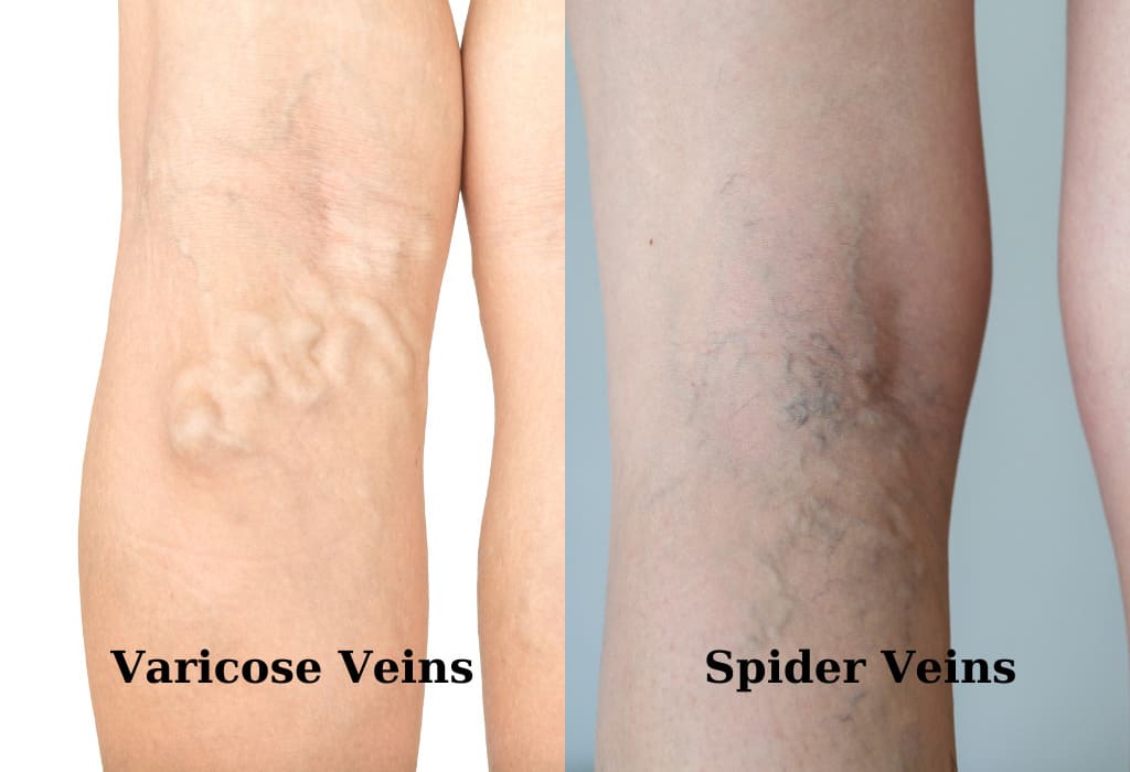 image of varicose vein and spider vein legs