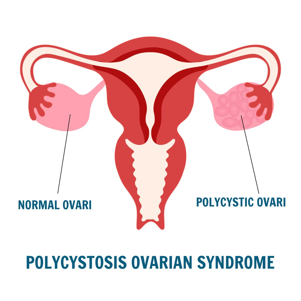 spearmint may help with PCOS