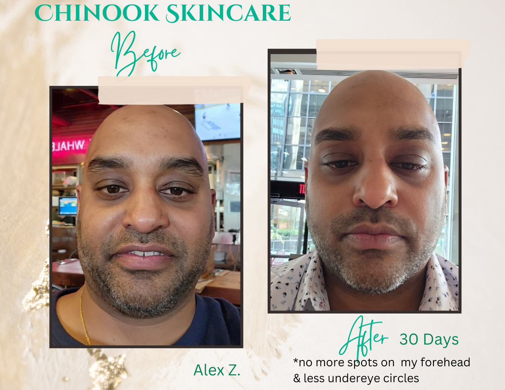 Alex Z before & after using Chinook Skincare system photos