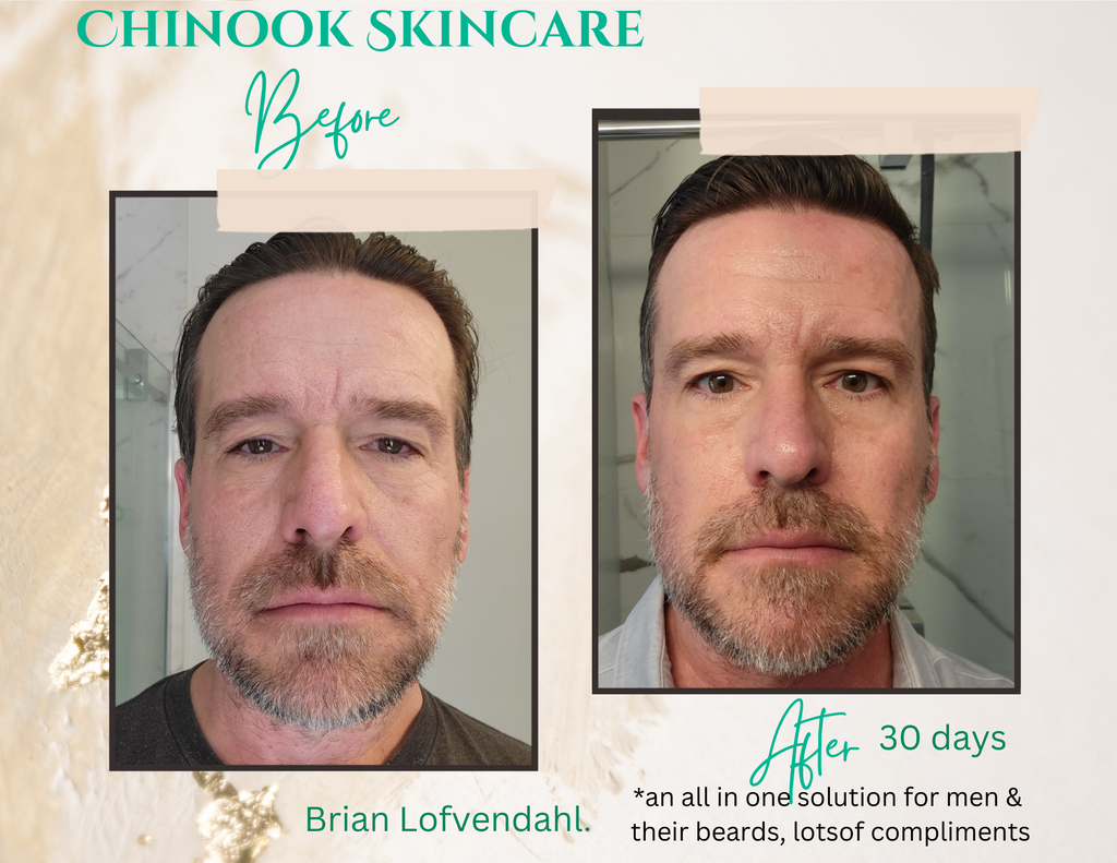 Brian L's before & after photos after using Chinnok Skincare system