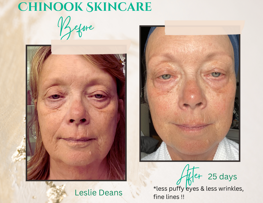 Leslie Dean's before & after photos after using Chinook Skincare system