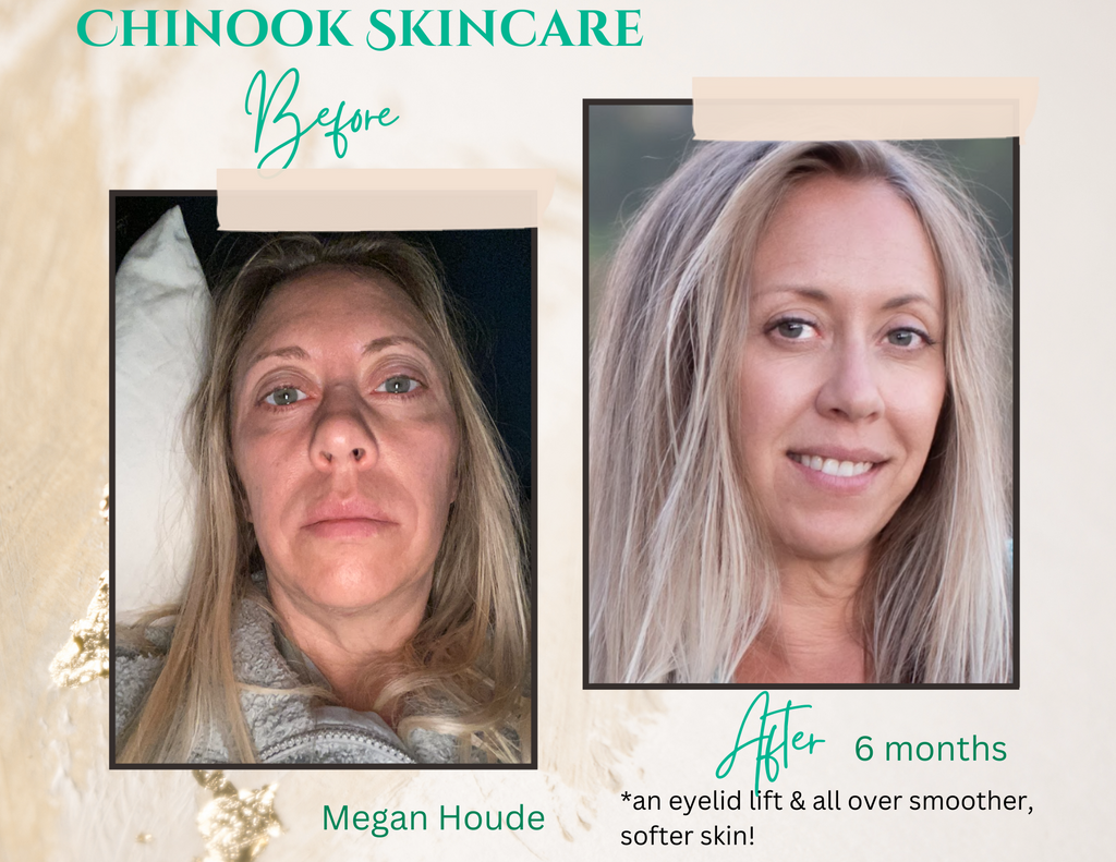 Megan's before & after photo after six months of using Chinook Skincare system