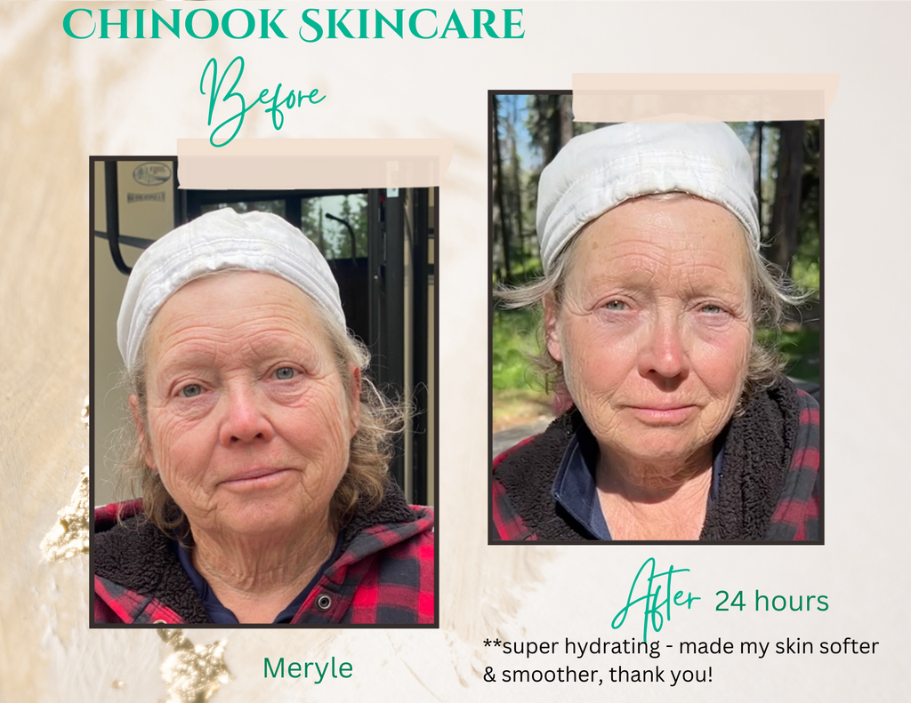 Meryle's before & after photos after using Chinook Skincare for 24 hours