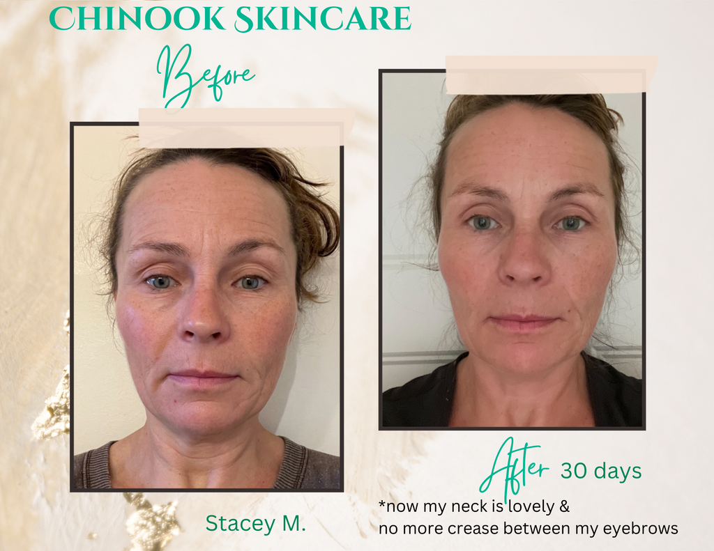 Stacey's before & after using Chinook Skincare system photos