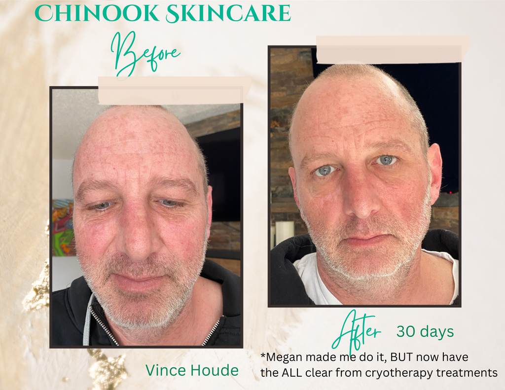 Vince Houde's before & after photos after using Chinook Skincare system