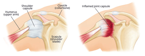 Frozen Shoulder Syndrome