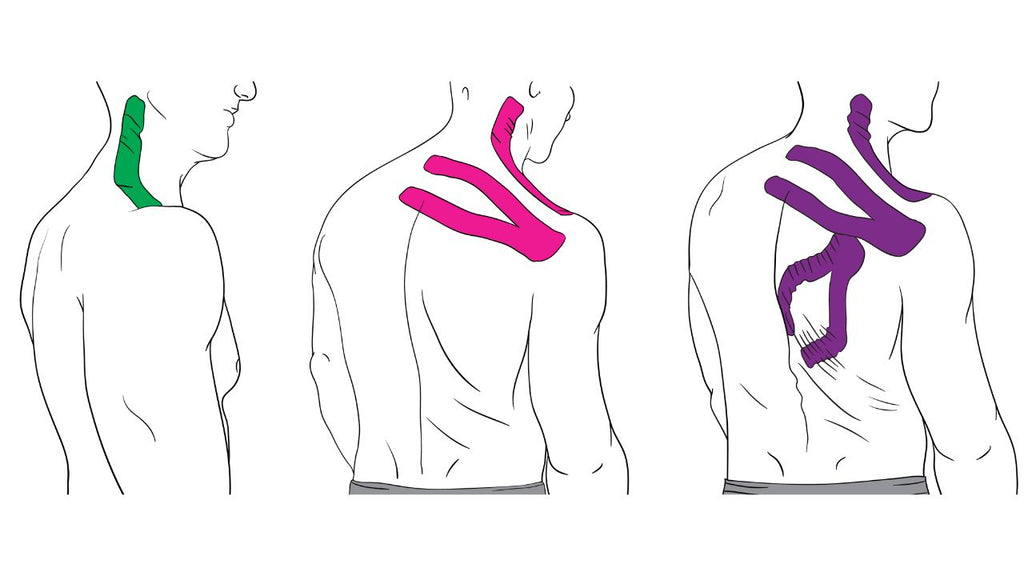 Taping for trapezius trigger points