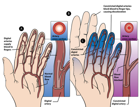 Raynaud's Syndrome Trigger Points