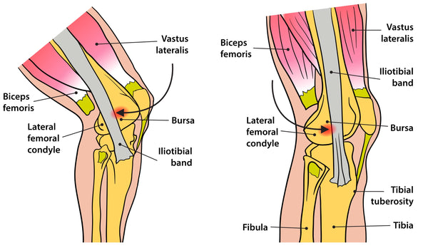 Iliotibial Band Syndrome Exercises - What You Need to Know