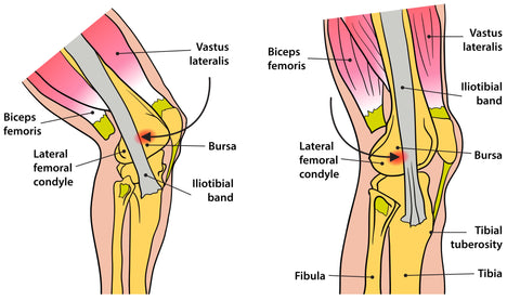 Trigger Point Therapy for Iliotibial Band Syndrome (ITBS) – Stuart Hinds  Performance Therapy