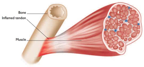 Quadriceps Trigger Points