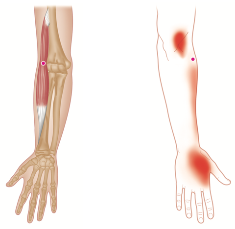 Brachioradialis-Triggerpunkte