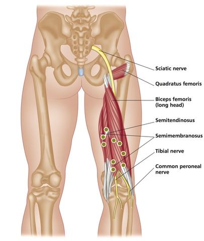 Hamstring Trigger Points