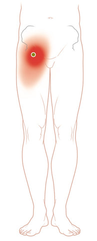 Pectineus Trigger Points and Groin Pain