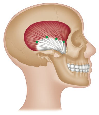 Terapia de puntos gatillo - Temporalis