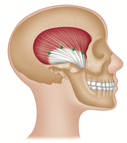 Tempralis Trigger Points