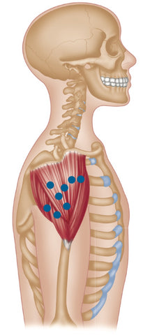 Deltoid Trigger Points