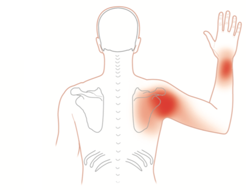 Subscapularis Trigger Point Pain Map