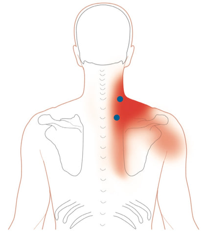 Levator Scapulae - Common Trigger Point Sites and Pain Patterns