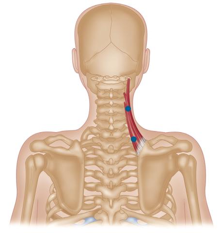 Levator Scapulae Triggerpunkte