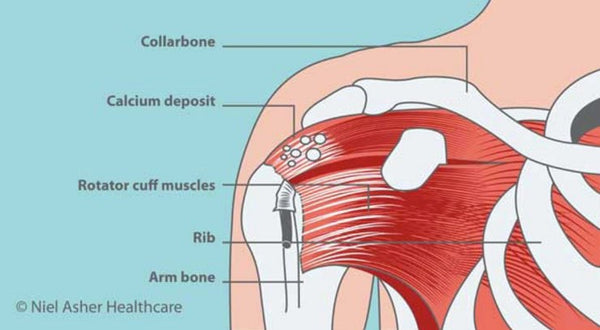 Calcific tendinitis