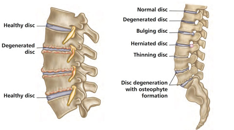 Degenerative Disc Disease Dallas, Spinal Disc Repair Fort Worth