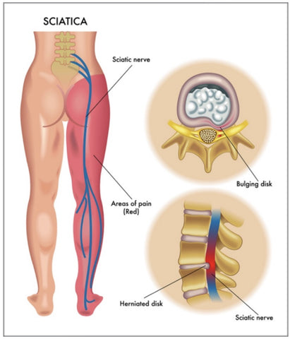 Ischias-Massage